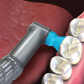 peridontal contra prophy angle