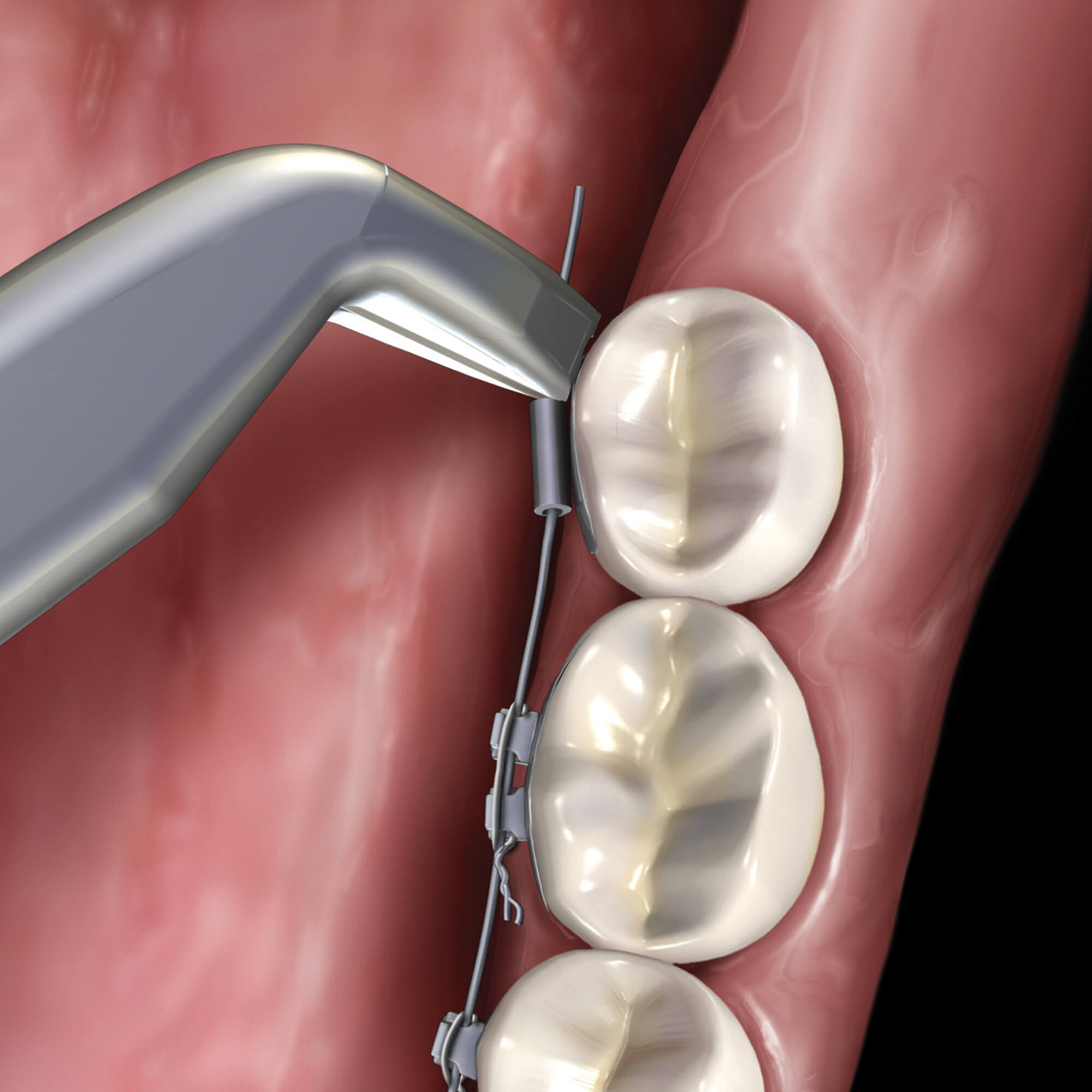 ALICATE CORTE LIGADURA HU-FRIEDY – Moltodent