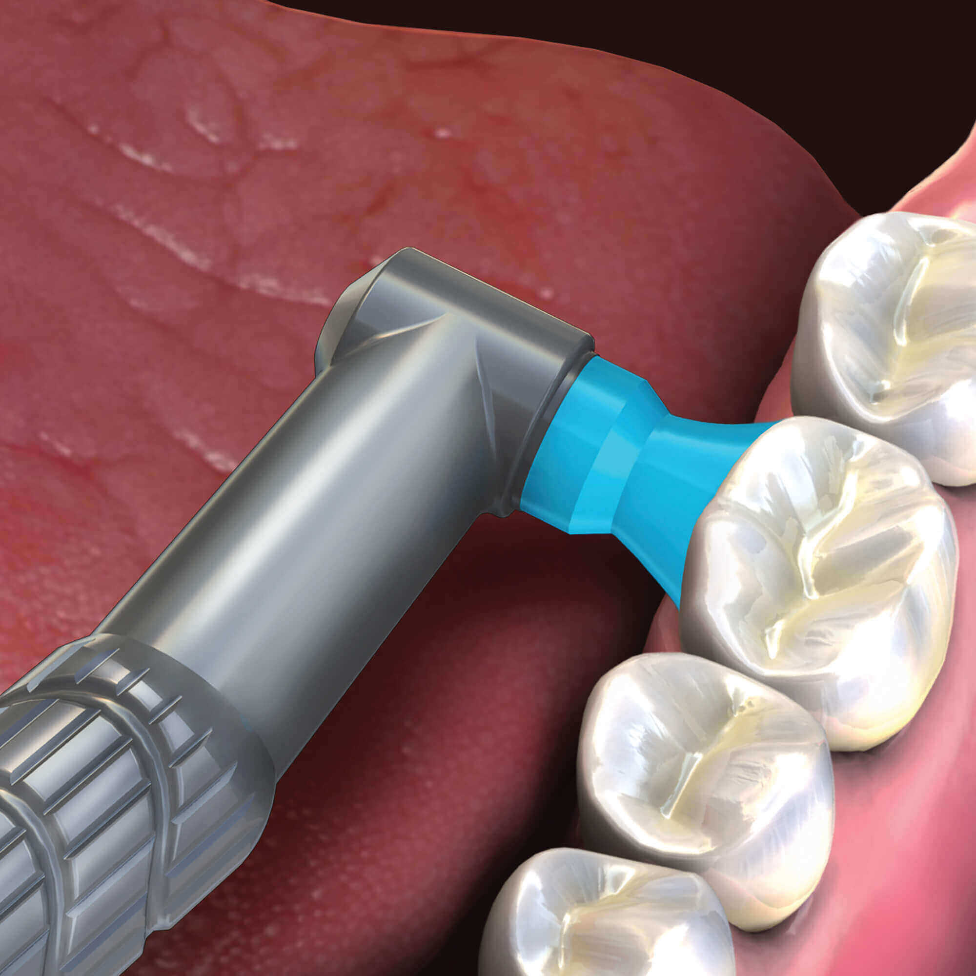 thumbnail image 2 of 500 Count Dental Disposable Prophy Angles - Soft Or Firm Cup, Latex-Free, Premium Quality By Pac-Dent 2 of 6