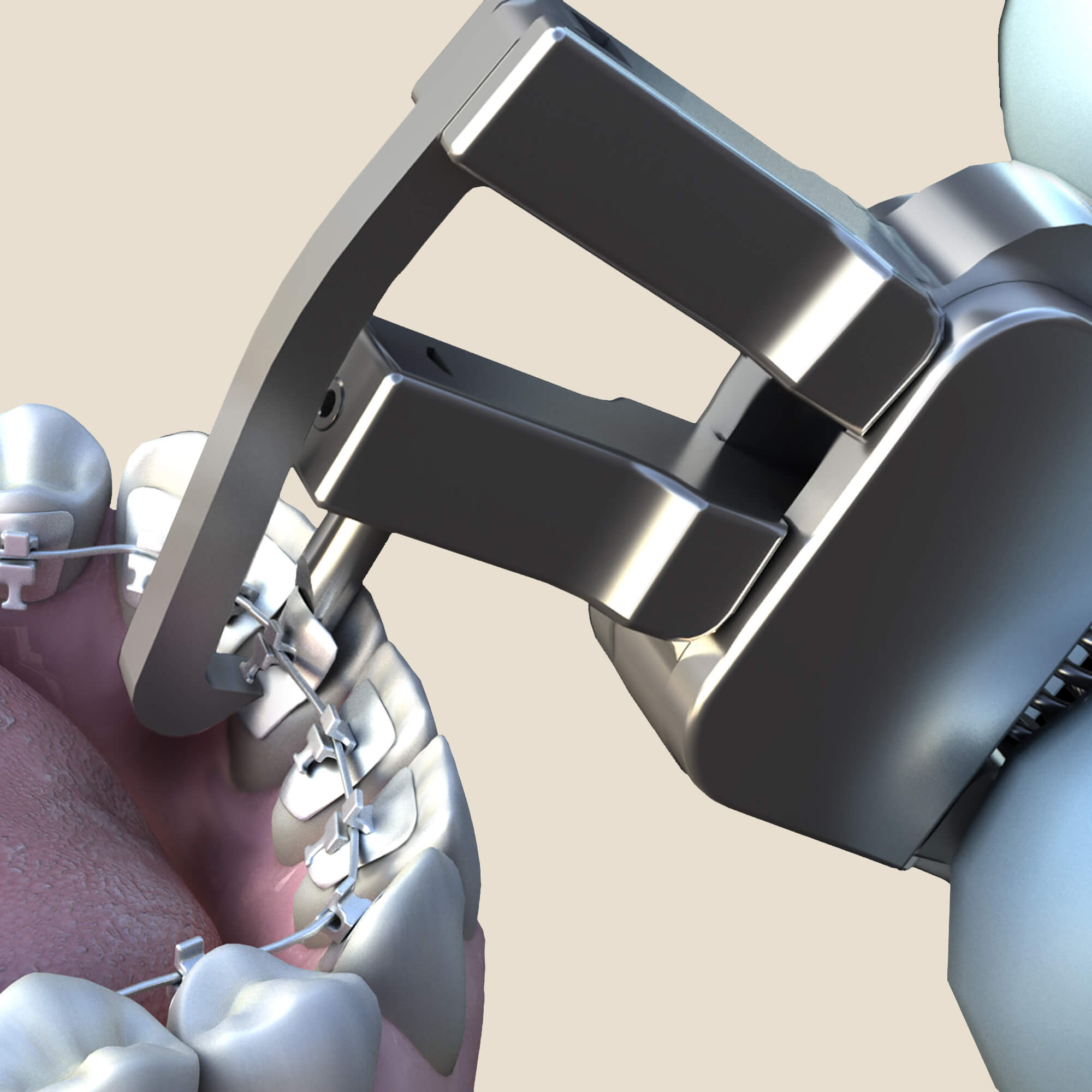 Lingual Debonding Pliers