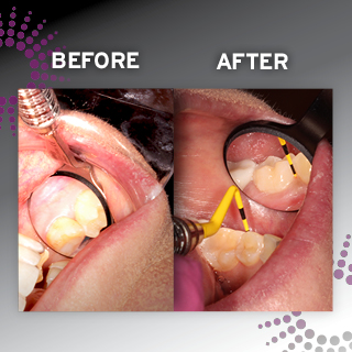 dental mirror reflection