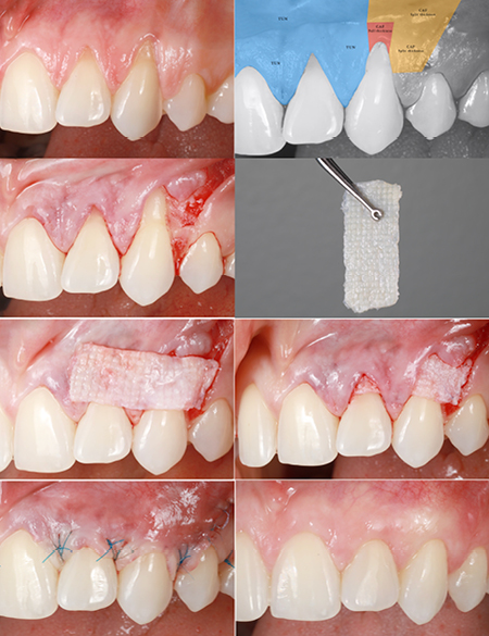 Treatment of maxillary anterior gingival recessions