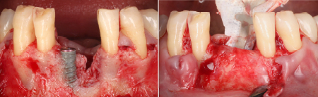 successful regenerative procedure
