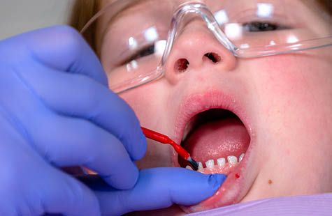 FLUORIDE VARNISH