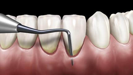 periodontal surgical knives and micro instruments