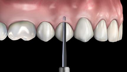 Periotomes and elevators extraction instruments