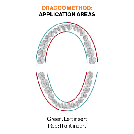 Left And Right Ultrasonic Inserts Adaptation Guide