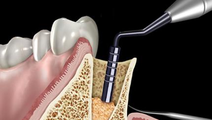 sinus lift instruments, bone condensers, surgical curettes and membrane placement instruments.