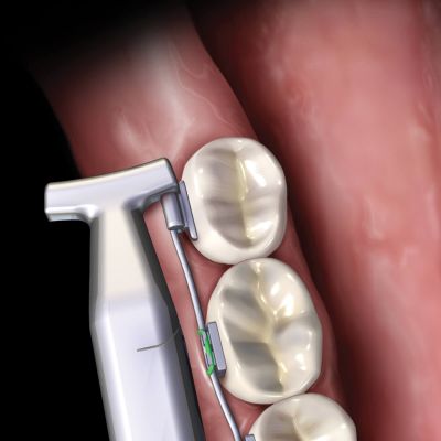 Slim Hammerhead® 镍钛丝弯制钳