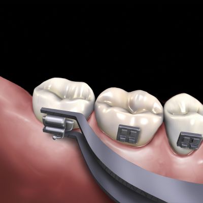 Slim颊面管粘结镊子