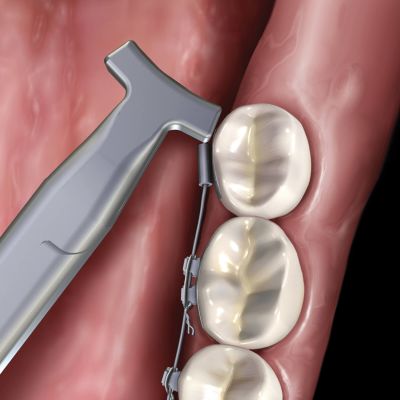 舌侧镍钛丝末端回弯钳