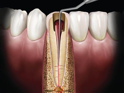 GP1 根管侧方加压充填器，黑金系列