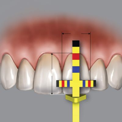 T-Bar Replacement Tips (3 Tips)