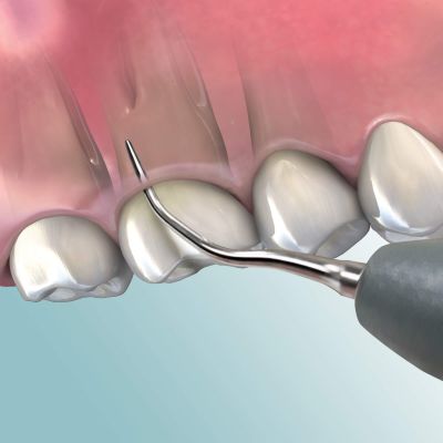 XT Triple Bend Insert